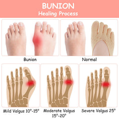 Aster bunion toe socks separate toes to reduce friction.