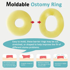 Atwlux moldable hydrocolloid barrier rings conform to irregular stoma shapes