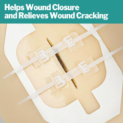 AZEN zip-stitch wound closure in use: easy zipper action seals small cuts