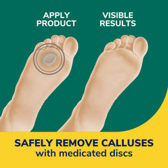 Dr. Scholl's extra-thick cushions protecting calluses from shoe pressure