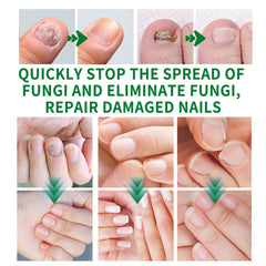 KUNLEN Nail Fungus Gel easy daily application and massage for absorption