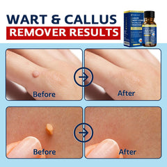 MEOLY mask covers a plantar wart area, showing precise surface coverage.