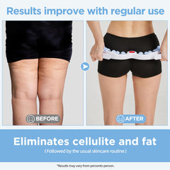 MZDXJ cellulite massage tool ideal for legs and thighs