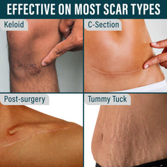 NUVADERMIS scar tape conforms for 24-hour wear on skin.
