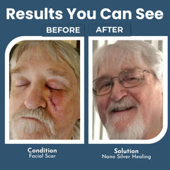 OPTIVIDA Colloidal Silver Gel on a minor wound for potential soothing care.