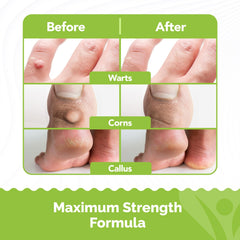Samsali corn and callus remover liquid for hard skin relief on feet.
