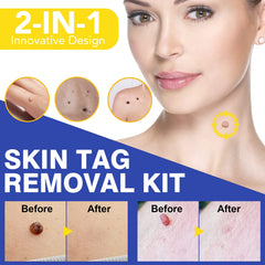 SHISUIZHE Cryogen application spot for precise skin tag treatment.