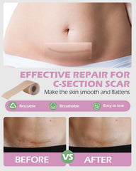 SOFTCA witch hazel pads offer cooling relief for postpartum care.