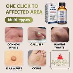 STAY STOKED Wart Remover foot closeup indicating targeted plantar wart care.