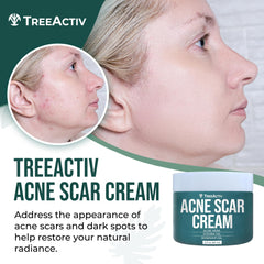 TreeActiv Acne Scar Cream texture swatch showing lightweight, non-sticky formula.