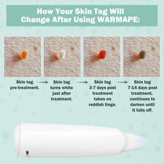 WARMAPE Skin Tag Remover in use shows precise application for safe home treatment