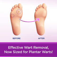Close-up of WartStick Plantar wax formula adherent to skin.