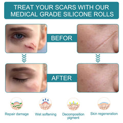 Scar tape applied over old and new scars for even coverage.