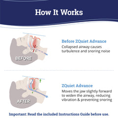 ZQuiet Advance mold trays for upper and lower teeth enable precise personalization