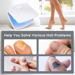 ZZP nail fungus light device nails before and after usage