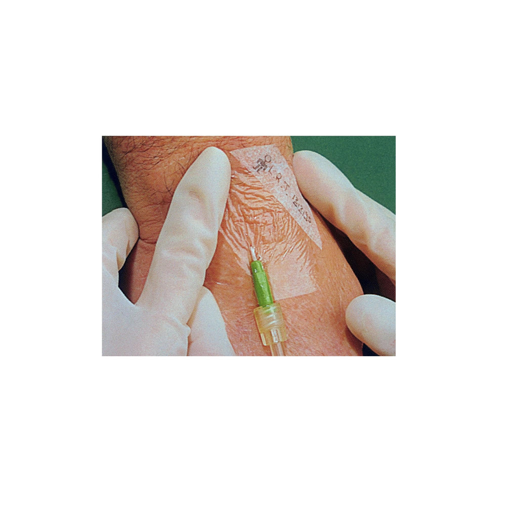 Picture-frame delivery enables precise placement of 3M Tegaderm frame-style dressing