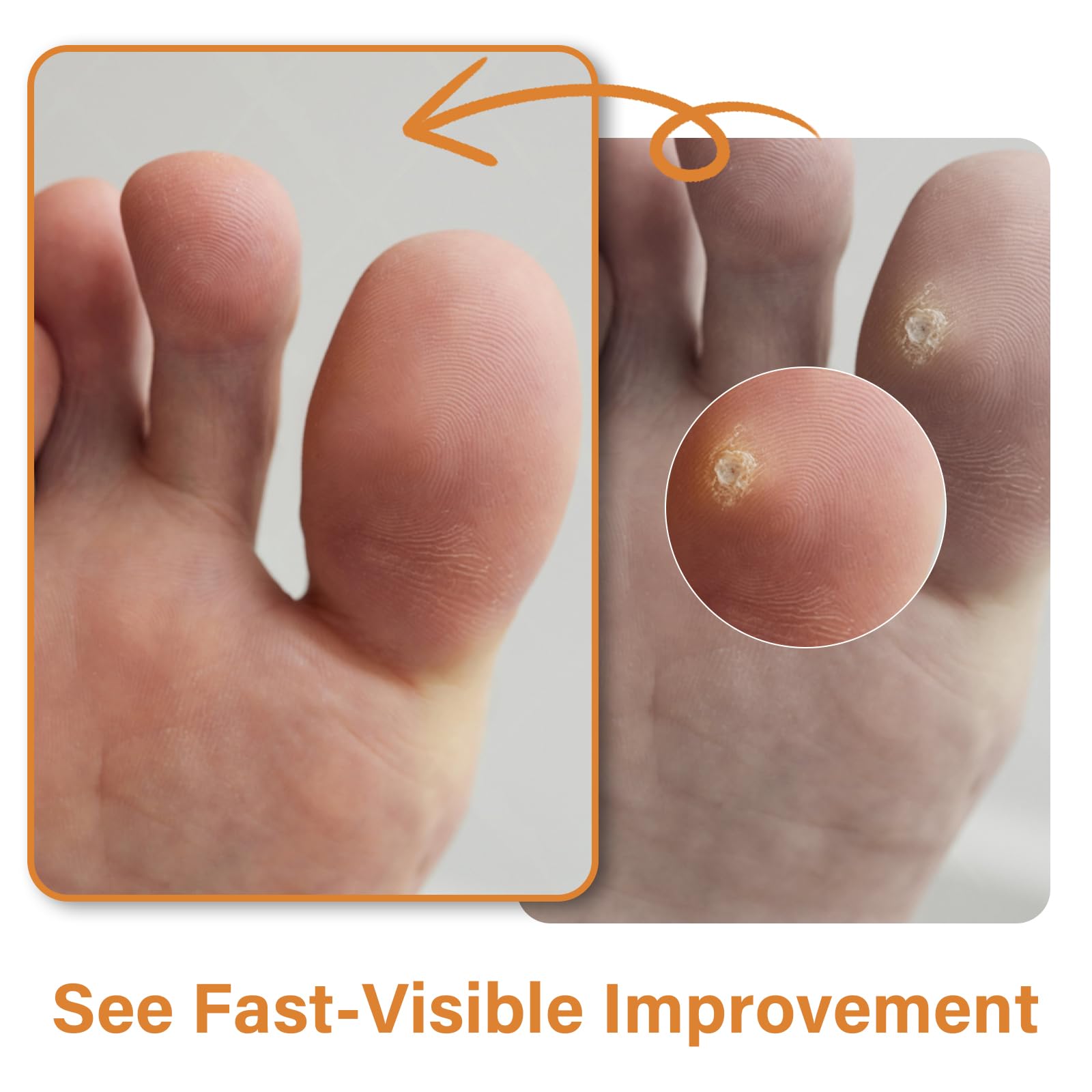 Feet treated with AEE pads on small corns.