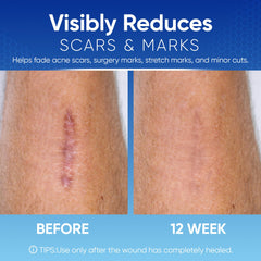 Aroamas Scar silicone tape applied on skin demonstrating gentle barrier