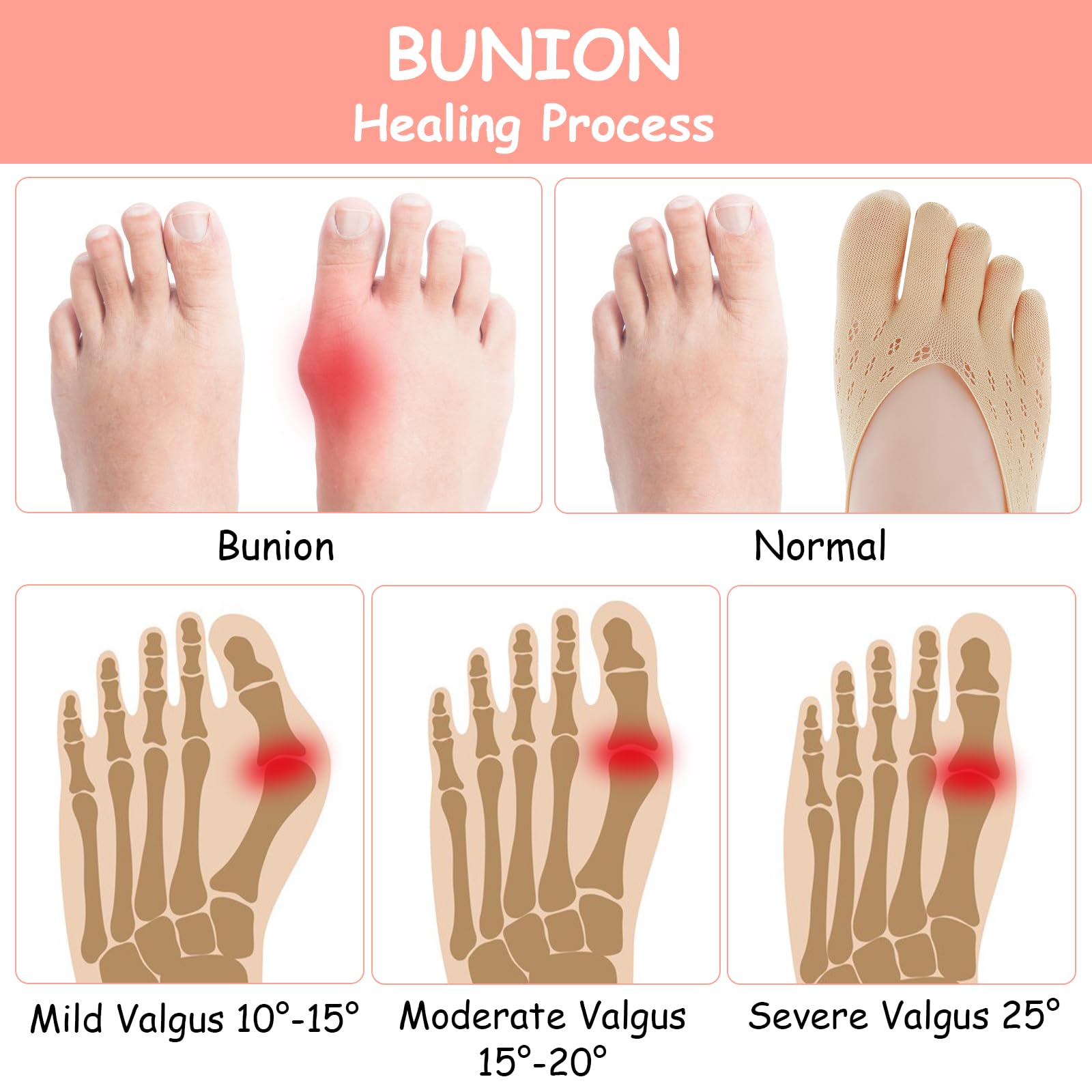 Aster bunion toe socks separate toes to reduce friction.