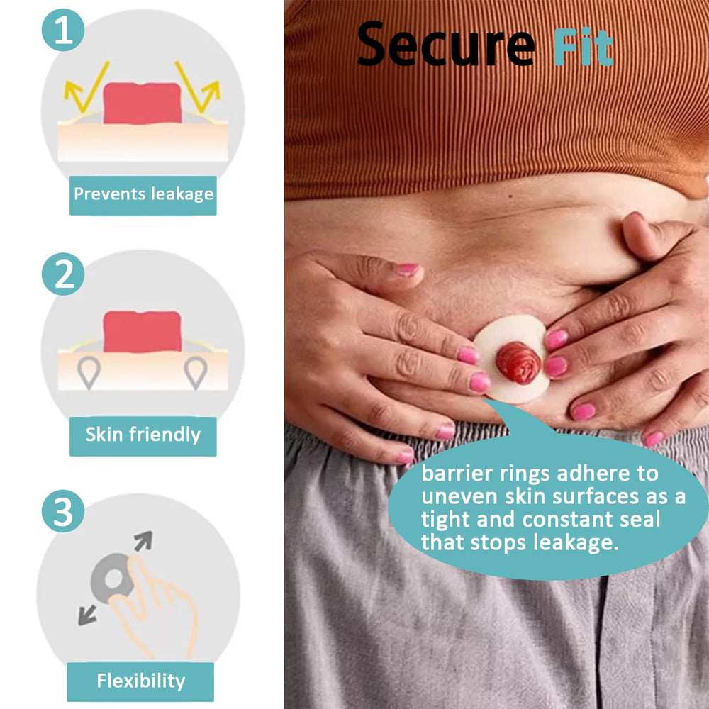 Atwlux barrier rings being trimmed to fit around a stoma