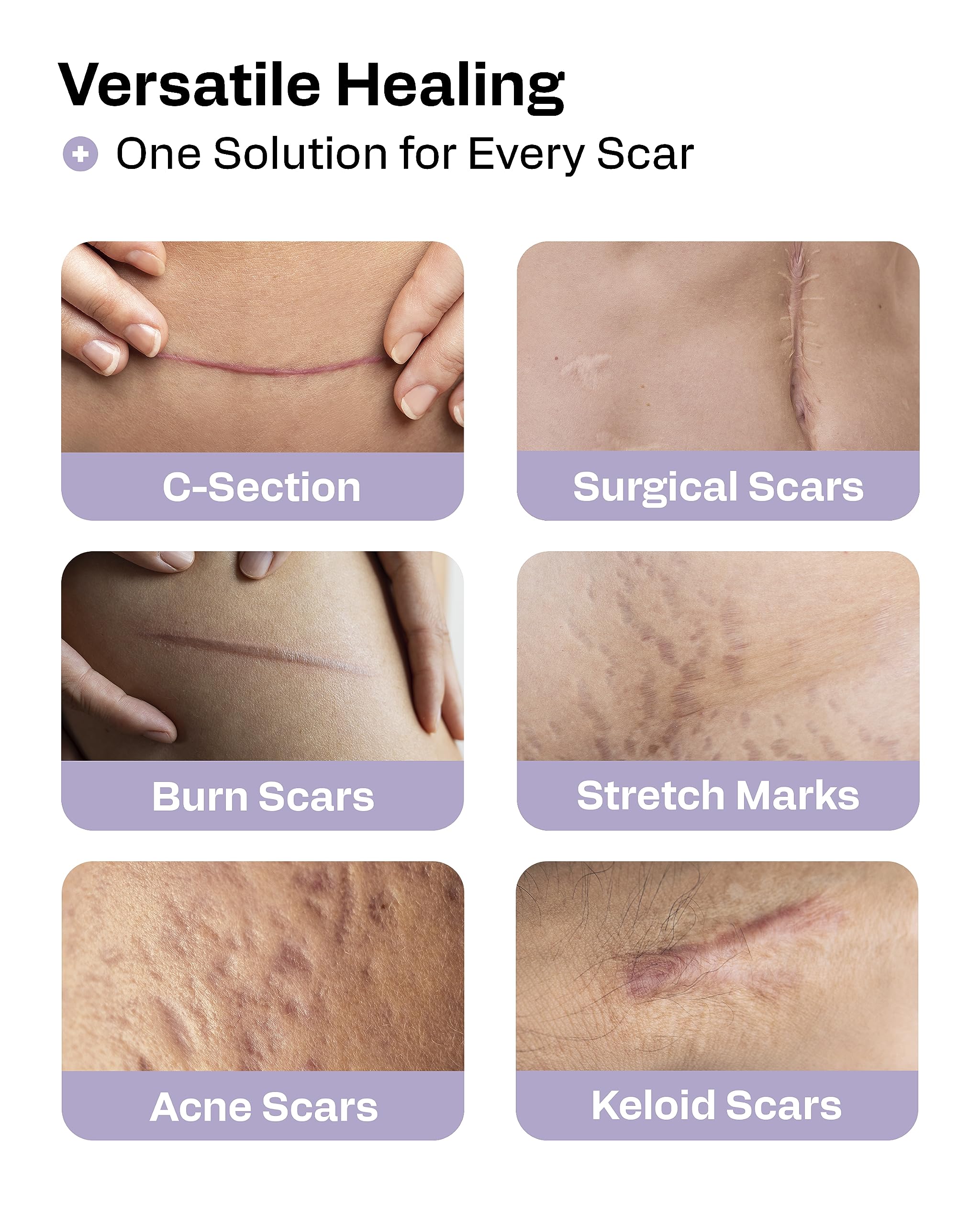 AWD Medical silicone scar tape roll 60in applied to a surgical scar area on skin.
