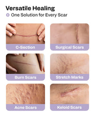 AWD Medical silicone scar tape roll 60in applied to a surgical scar area on skin.