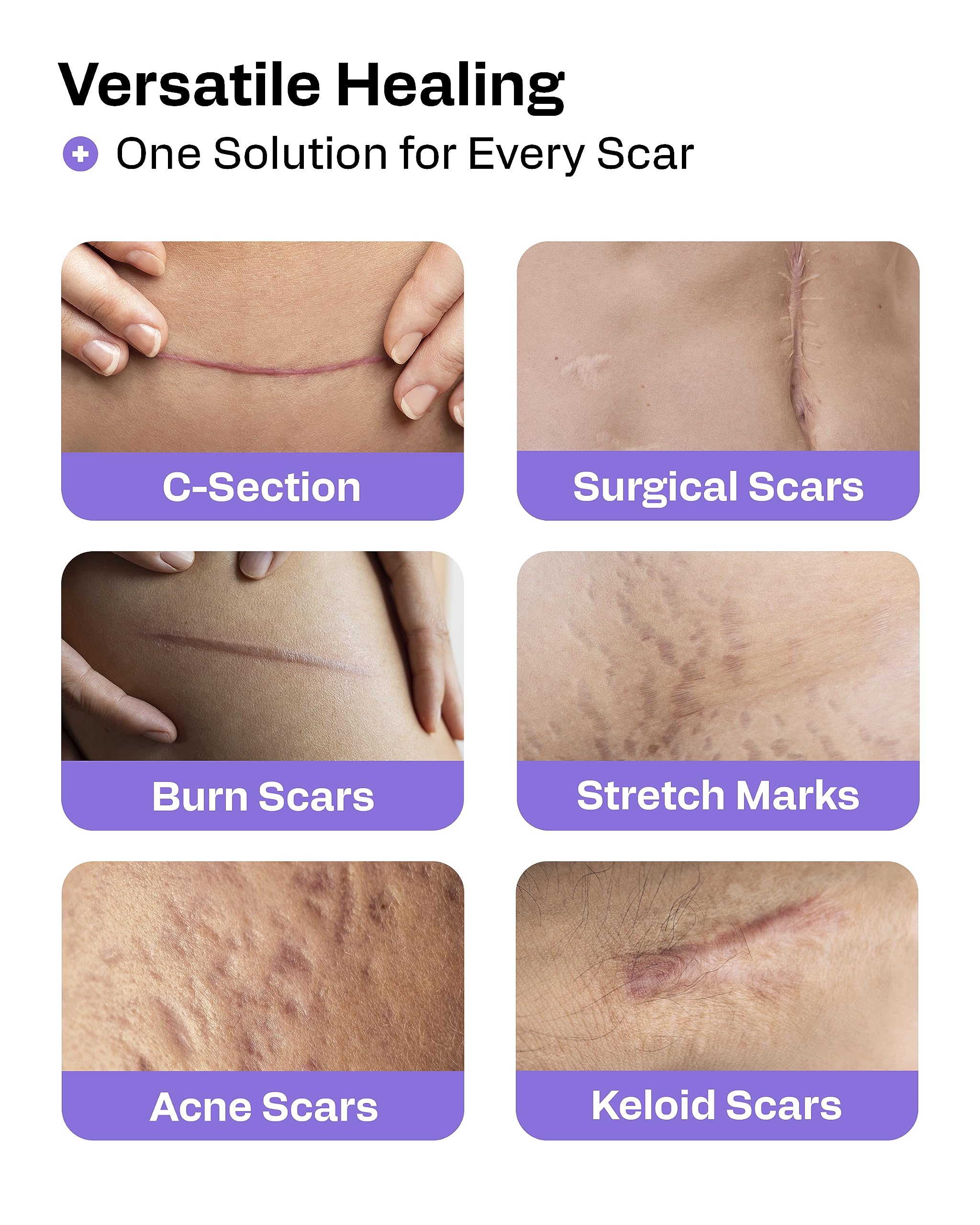 AWD Medical silicone scar tape on tummy area – post-surgical skin coverage