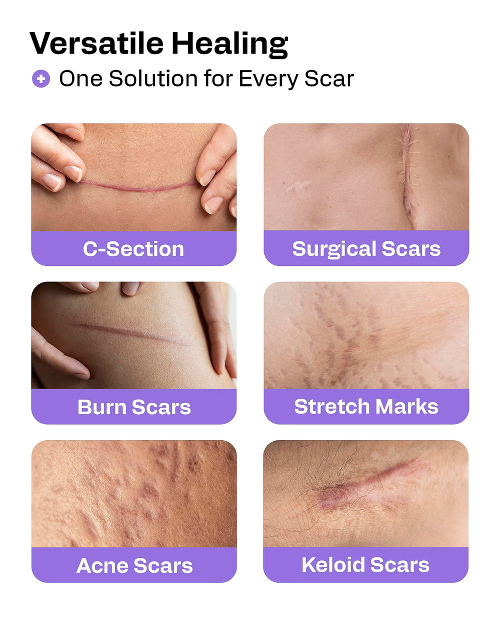 AWD Medical silicone scar tape on tummy area – post-surgical skin coverage