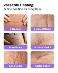 AWD Medical silicone scar tape on tummy area – post-surgical skin coverage