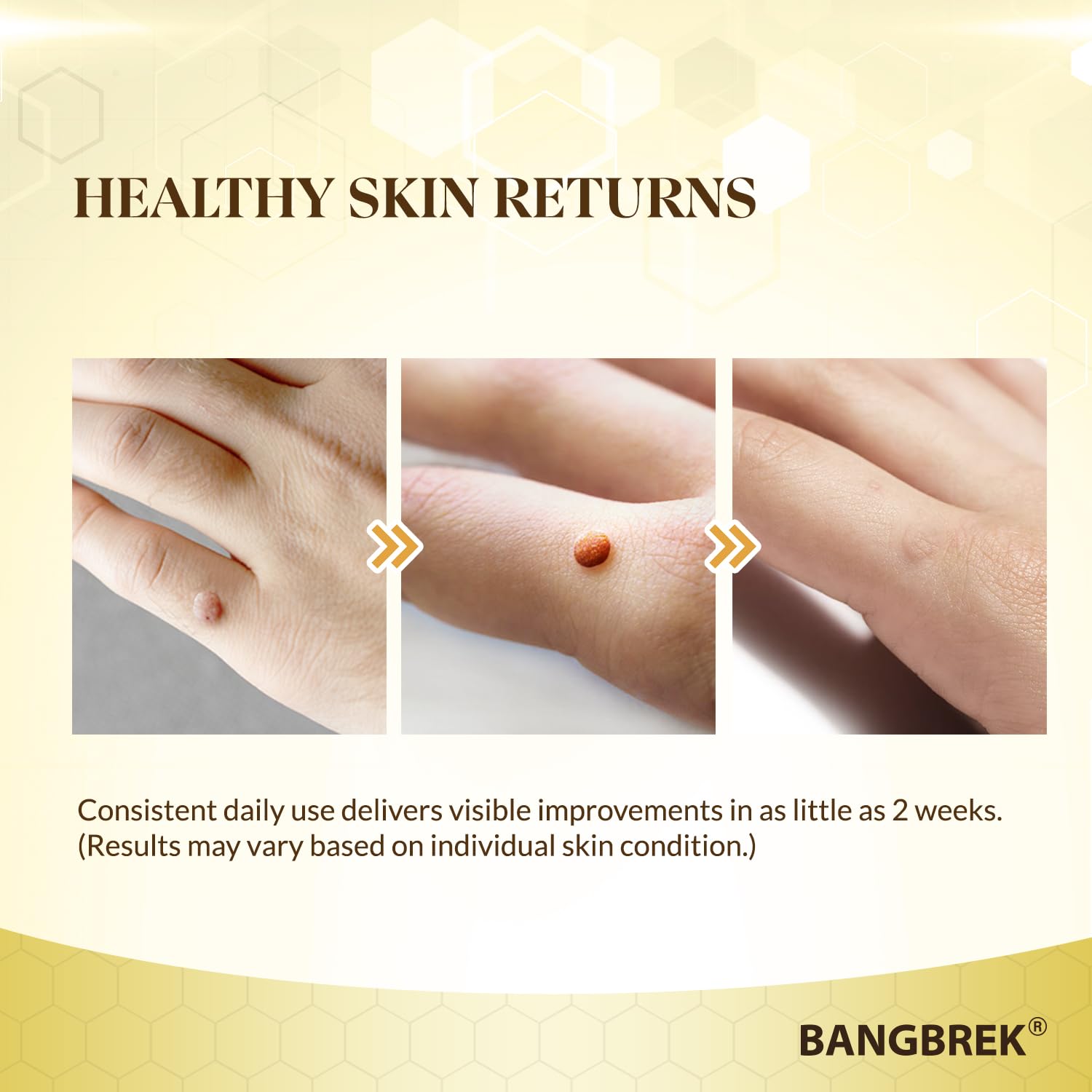 Foot skin after Bangbrek Bee Venom Wart Remover use shows smoother texture.