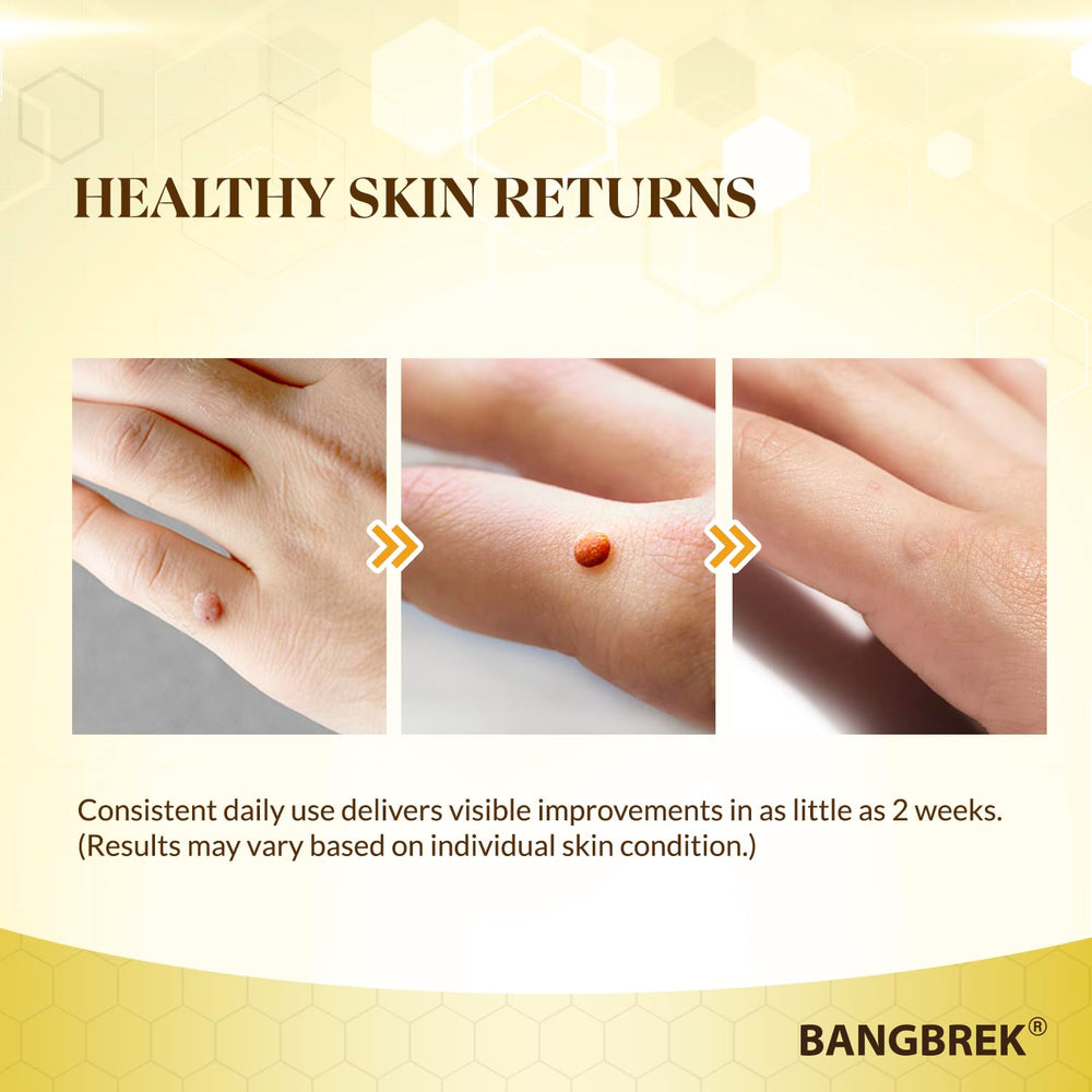 Foot skin after Bangbrek Bee Venom Wart Remover use shows smoother texture.