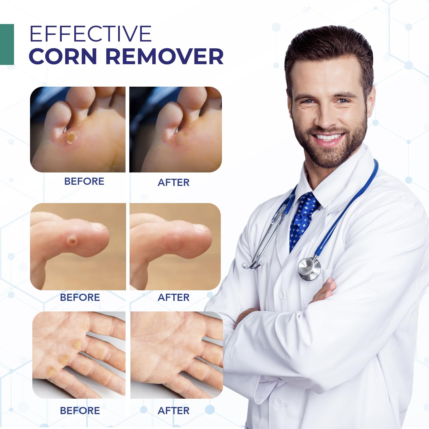 Bangbrek corn remover for calluses on toes and nails.