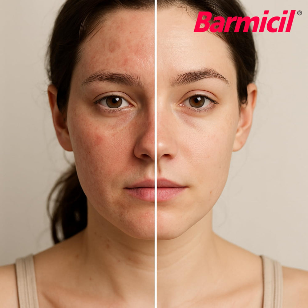 Applying Barmicil Plus Cream to skin for irritation relief.