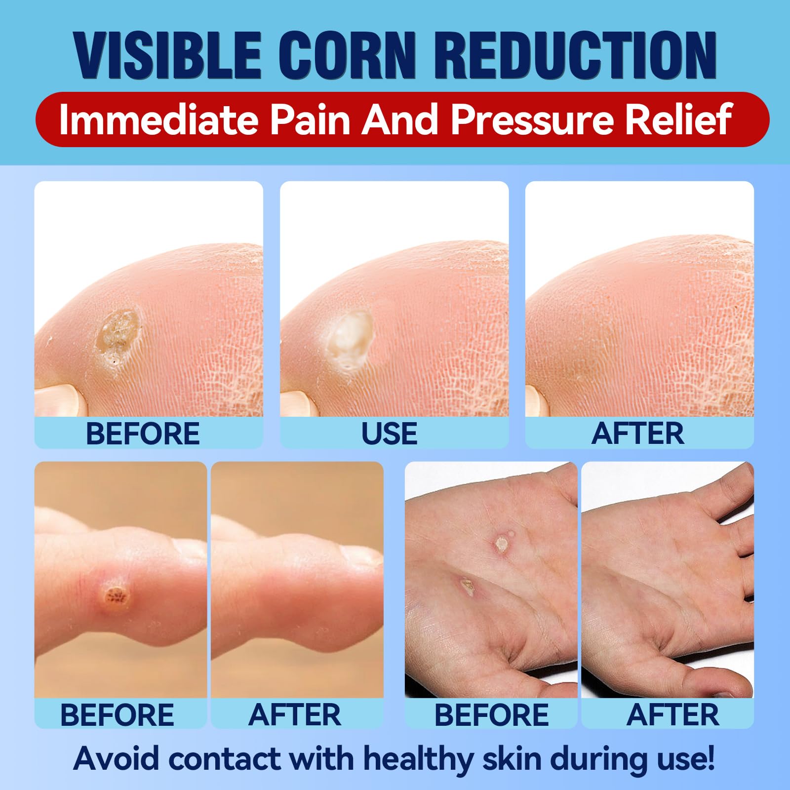 Bellemora callus remover pads absorb pressure for comfortable walking.