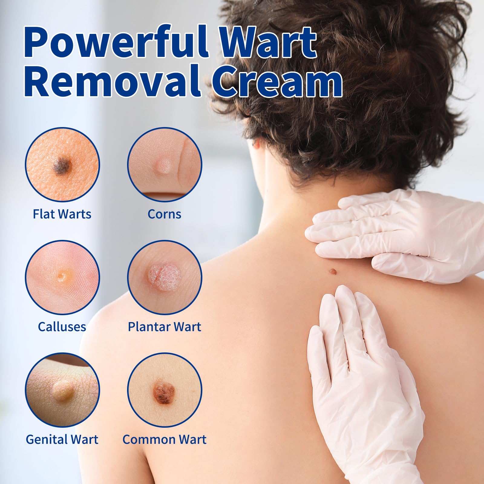 Bighero wart remover gel packaging shown for convenient home use.
