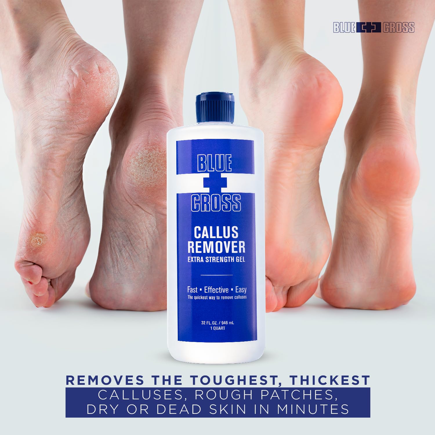 Blue Cross Callus Remover Gel used with pumice stone for smoothing.