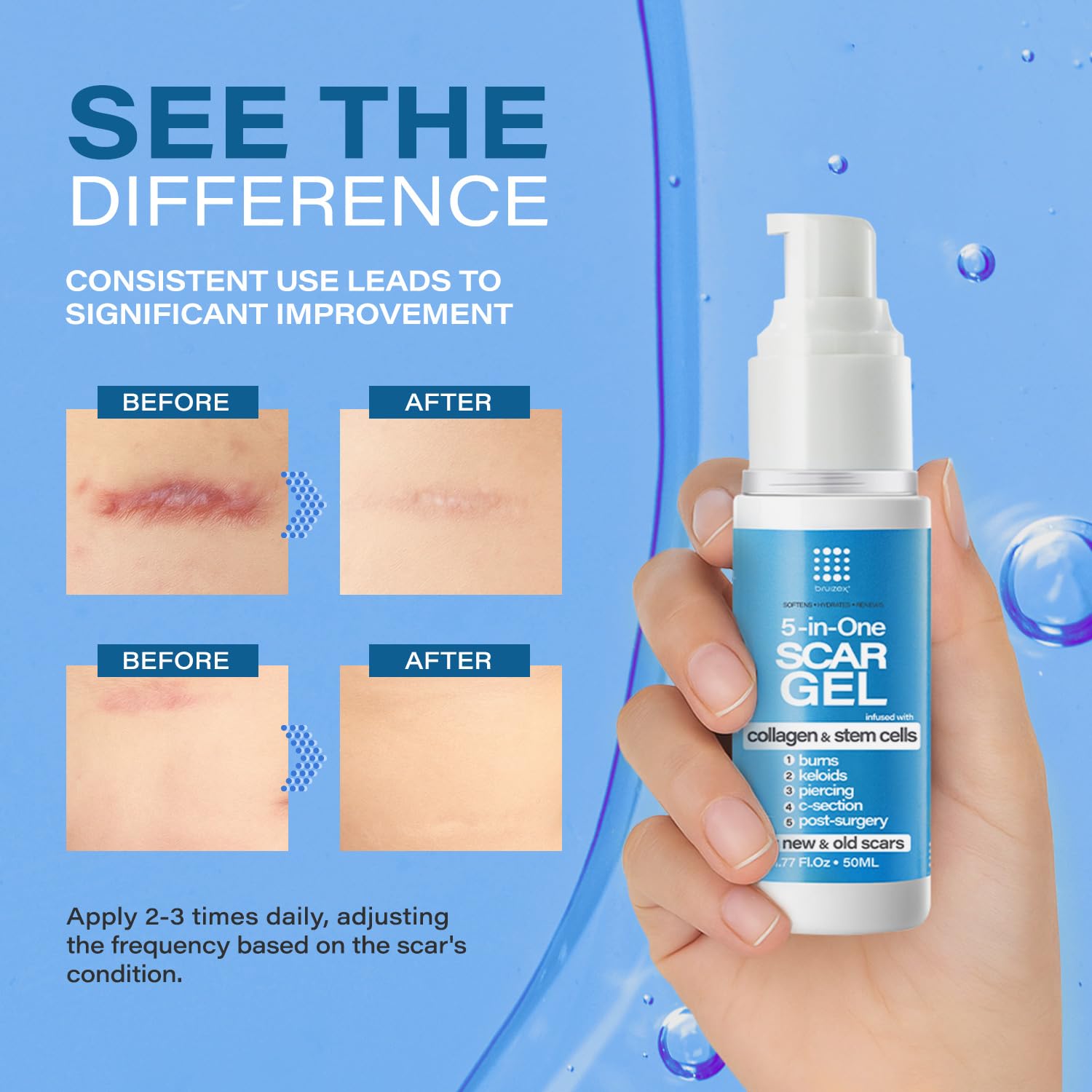 Bruizex stem cell extract promotes skin rejuvenation around scar areas