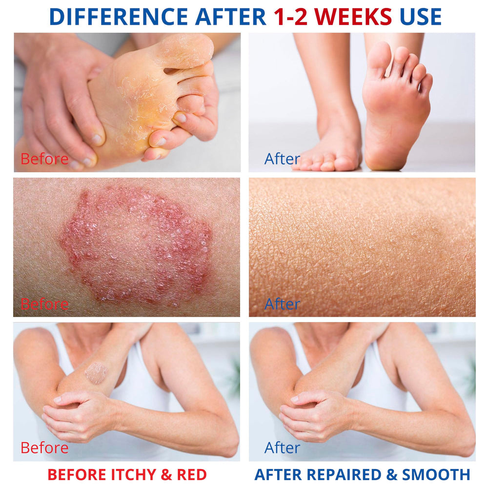 CHARMPOO foot care application scene showing non-greasy spread on skin