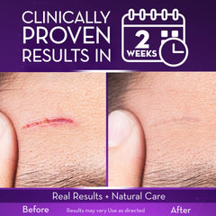 Cicatricure Advanced Scar Gel being applied to skin.