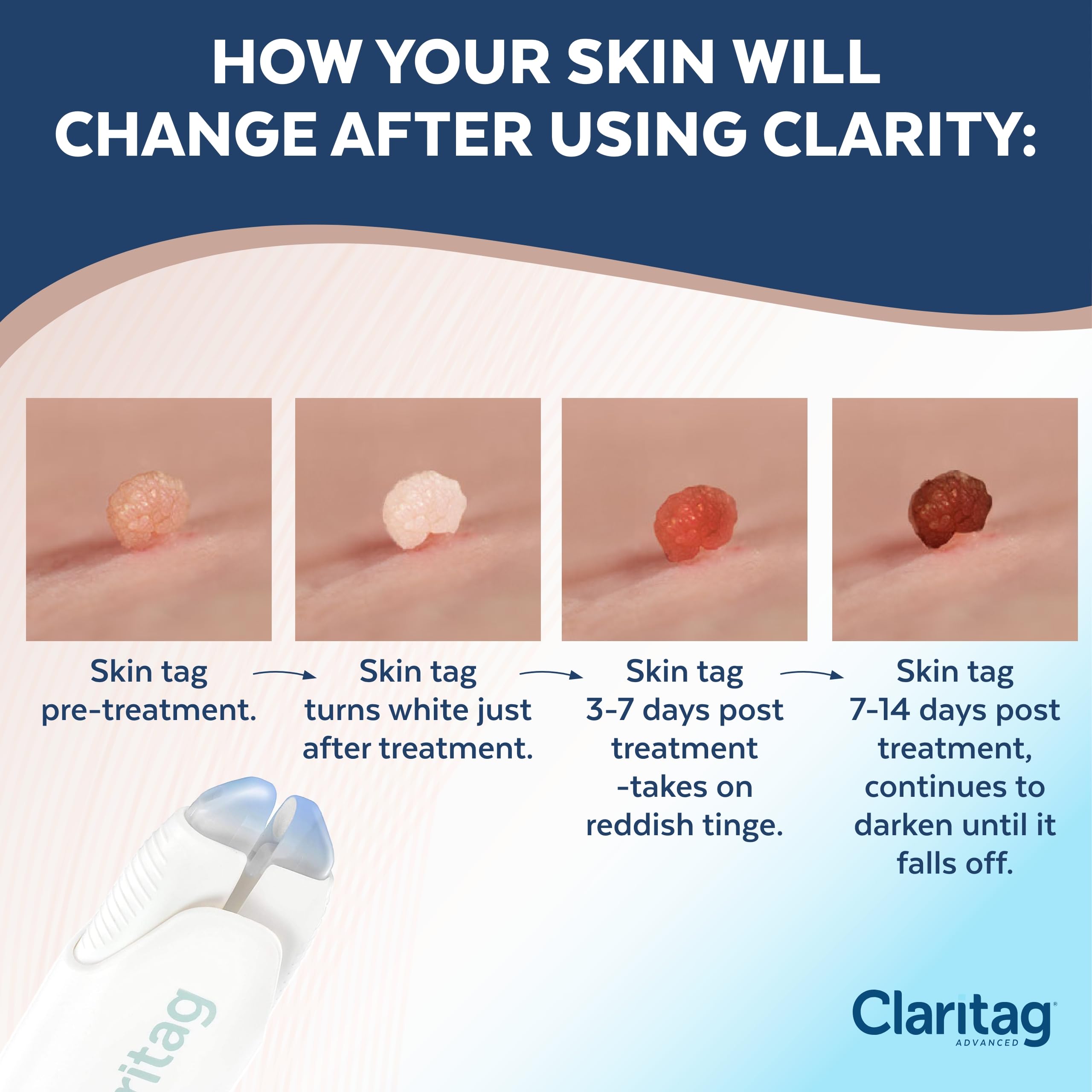 Claritag treatment-cycle diagram explains step-by-step use