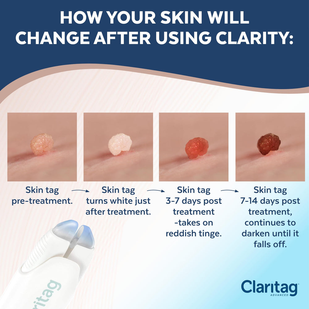 Claritag treatment-cycle diagram explains step-by-step use