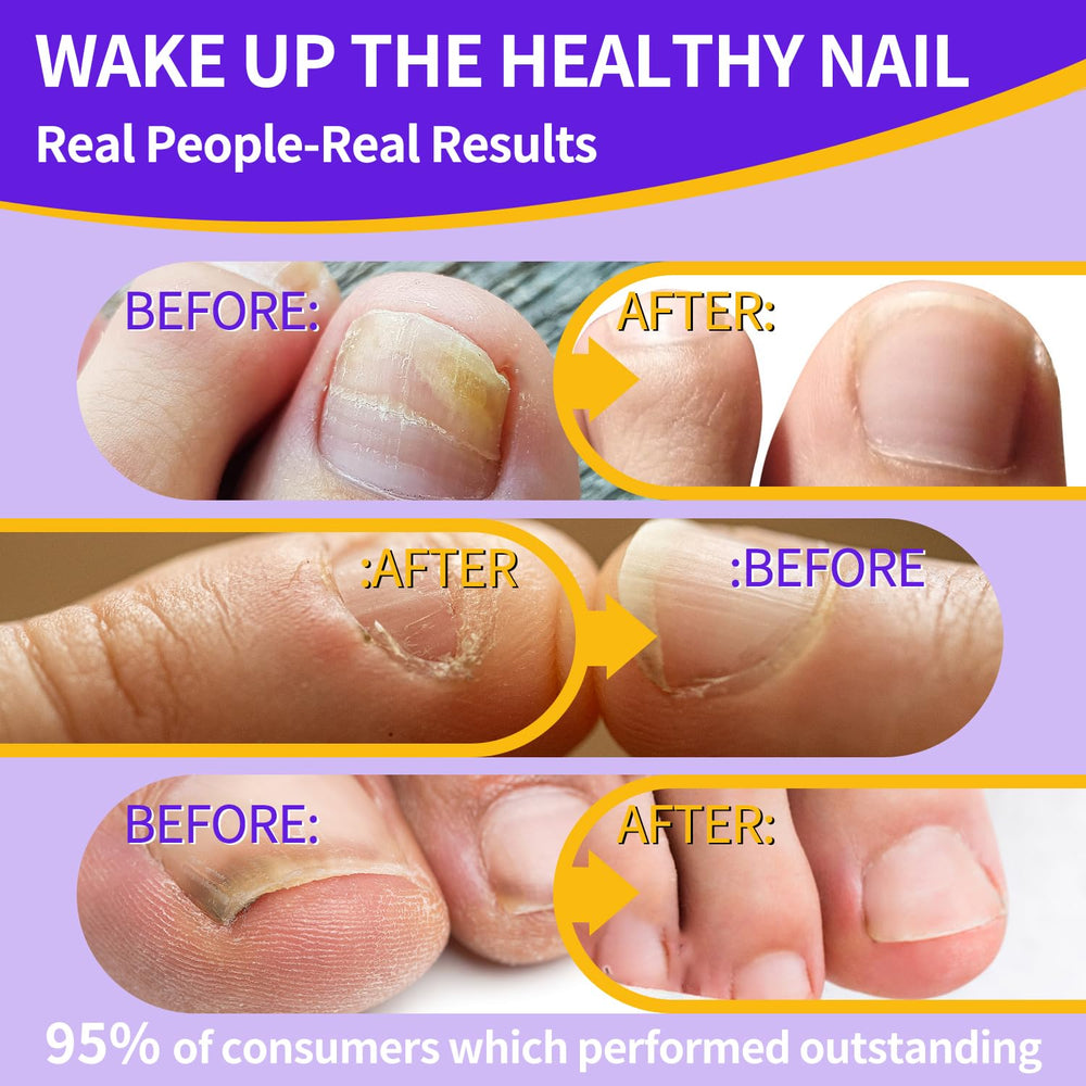 Comfort thick damaged nails shown transitioning with gentle care