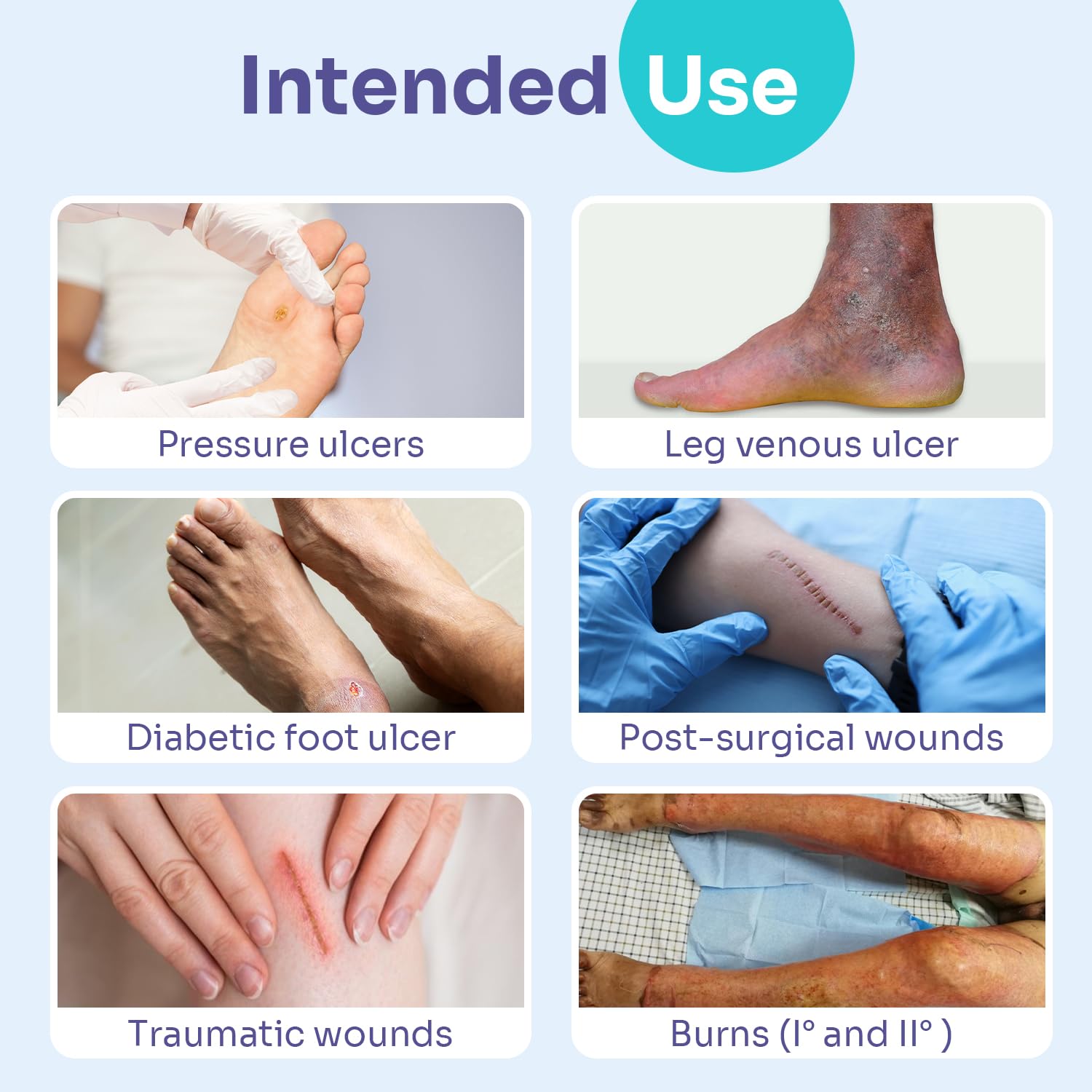 Conkote foam dressings suit multiple scenarios from postoperative care to ulcers