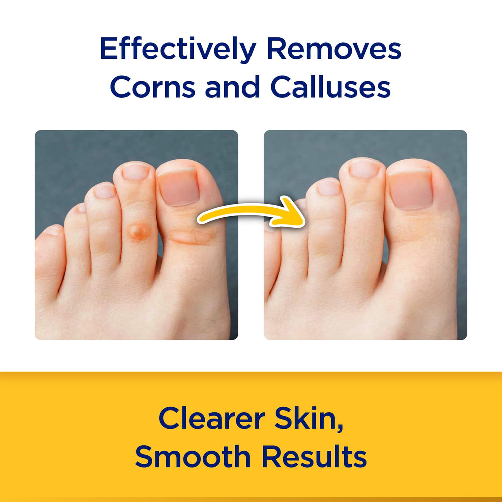 CornStick foot-sole closeup highlights targeted callus removal potential