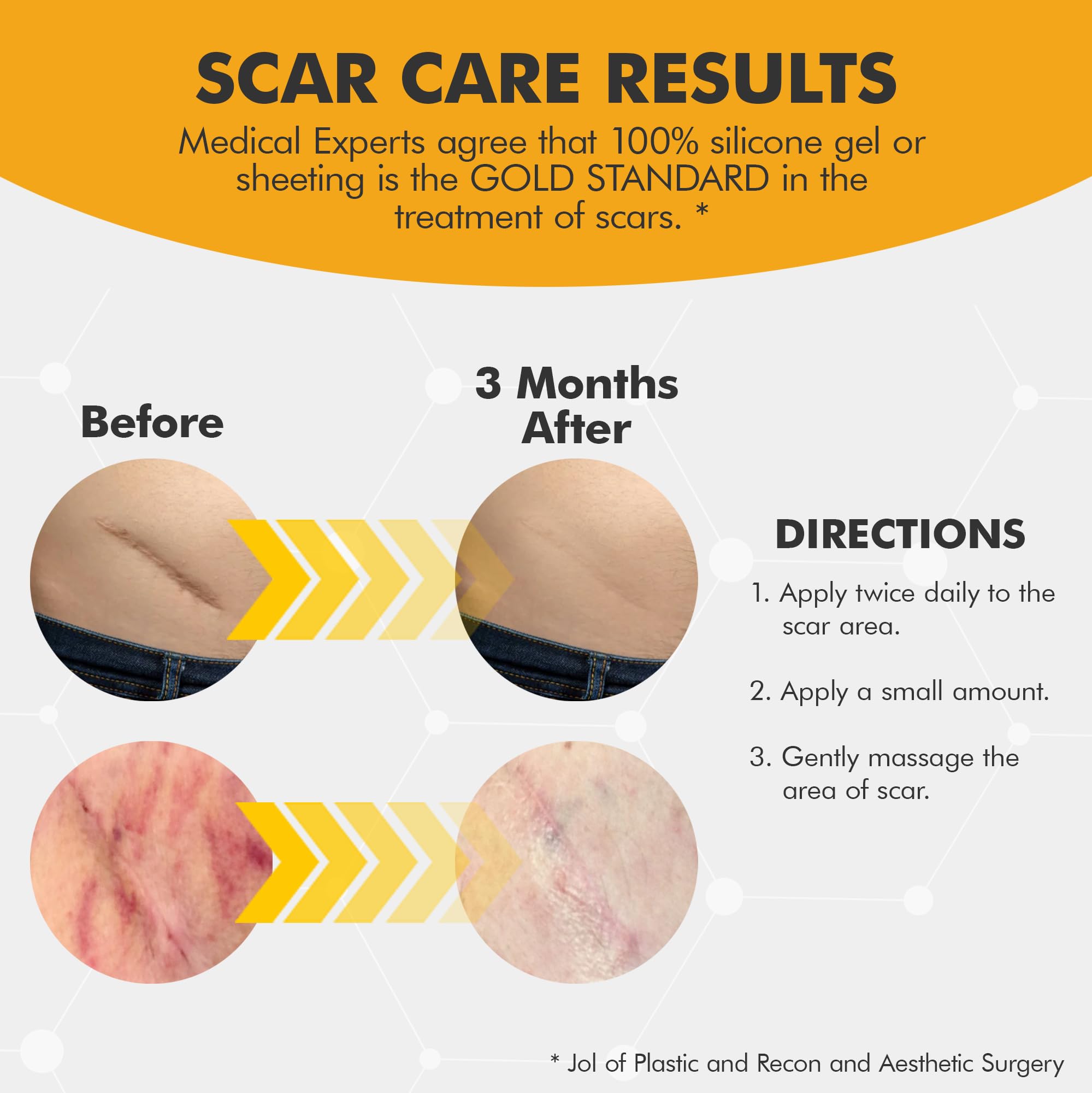 DermAvance Pure Scar Care for surgical scar shows potential improvement over time.