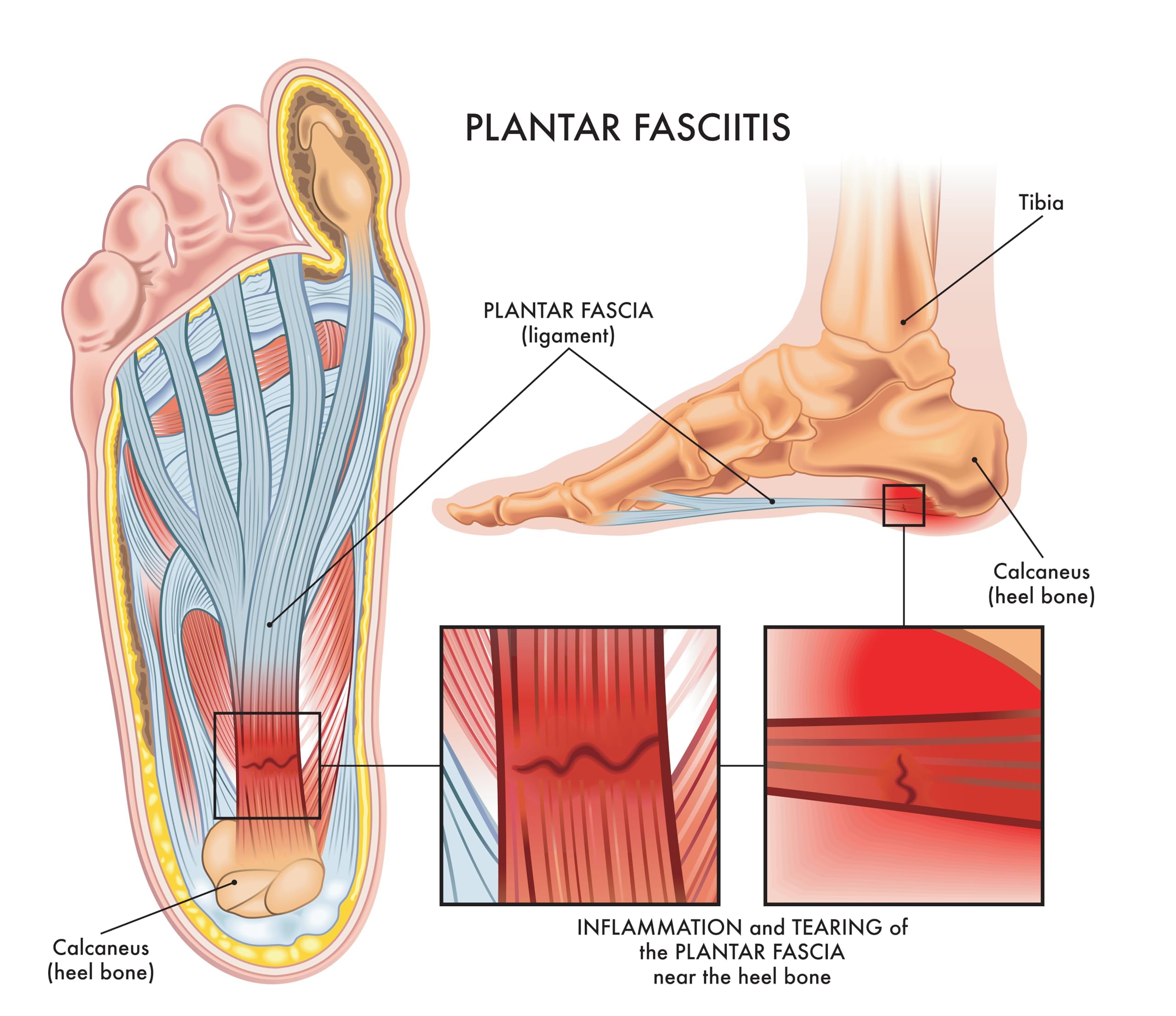 Application on foot showing patch placement for targeted relief with Dr. Luke.