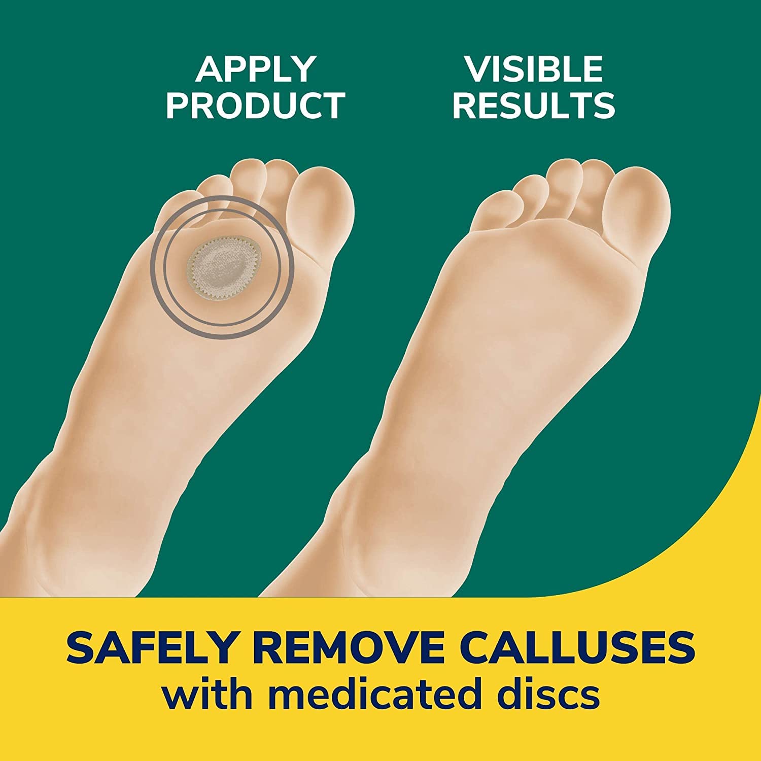 Application view demonstrates easy use and targeted callus care
