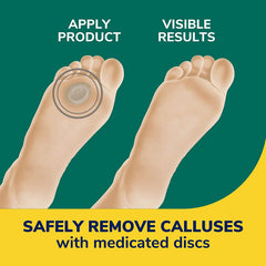 Application view demonstrates easy use and targeted callus care