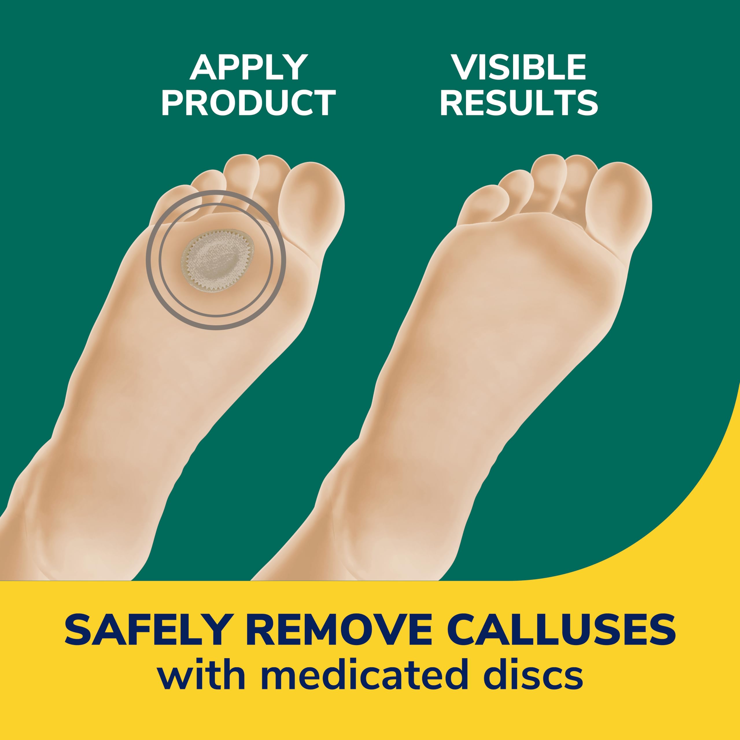 Dr. Scholl's extra-thick cushions protecting calluses from shoe pressure