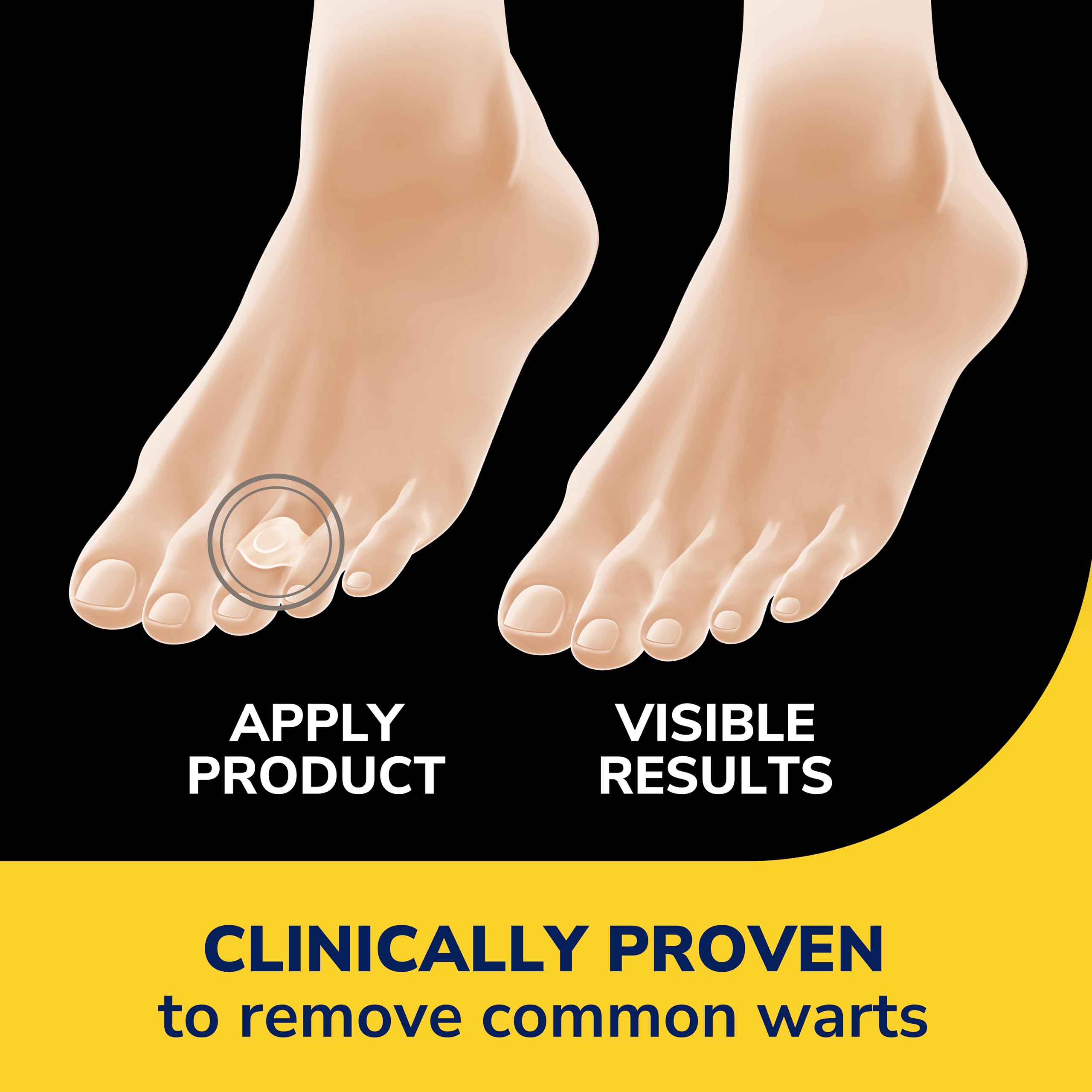 Dr. Scholl's wart remover bandages pack front shows discreet, ready-to-use treatment.